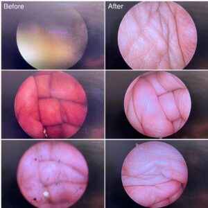 Image repair on rigid endoscopes