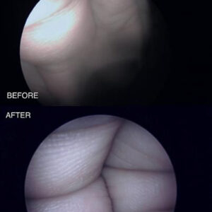 Image repair on rigid endoscopes